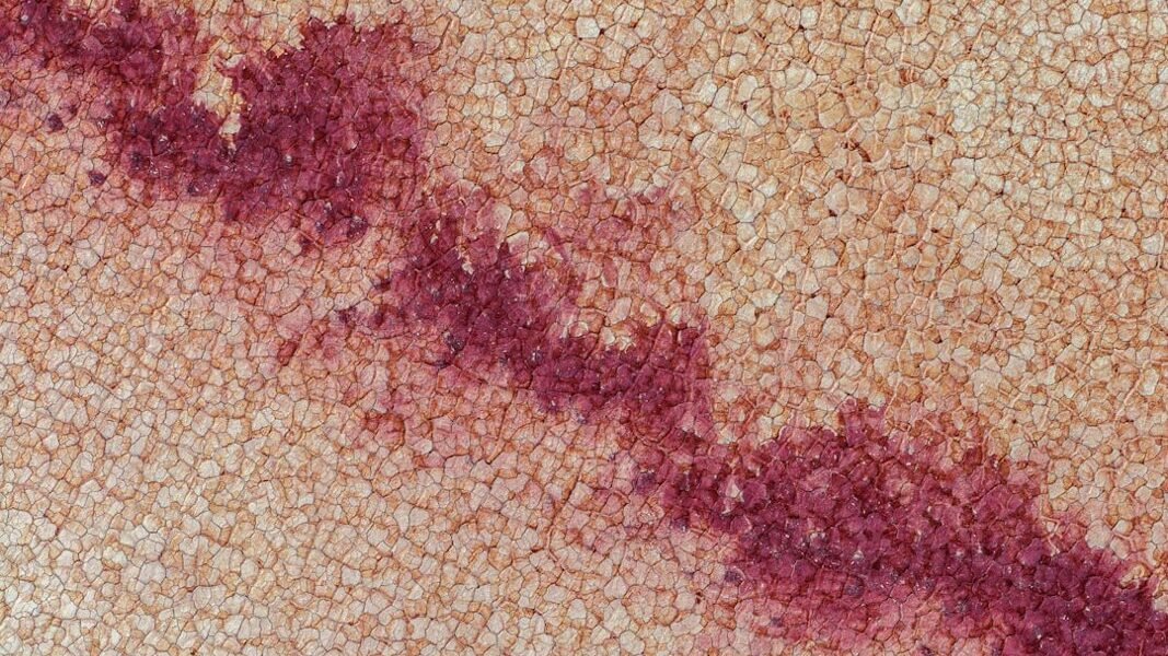 Sarampión en México: cifras en ascenso y alertas sanitarias