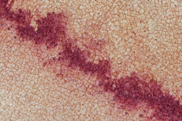 Sarampión en México: cifras en ascenso y alertas sanitarias