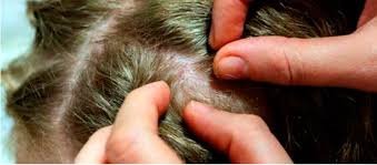 IMSS advierte: evita remedios caseros contra piojos, acude a médico