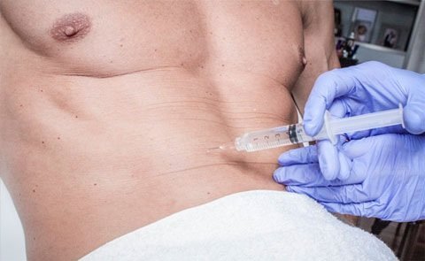 Mesoterapia corporal: la técnica que los hombres eligen para eliminar celulitis