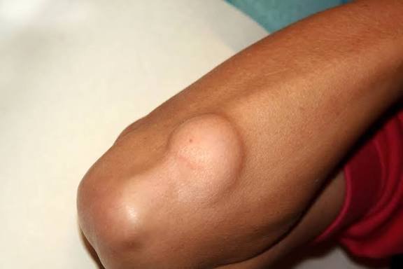 Detección temprana del sarcoma: clave para conservar extremidades